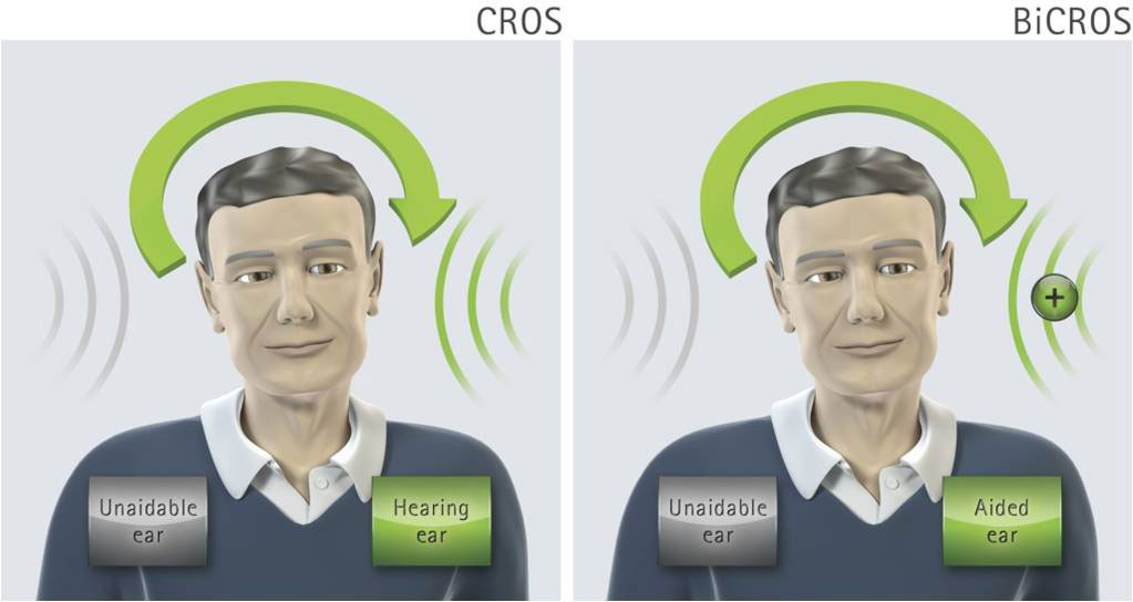 CROS助聽系統